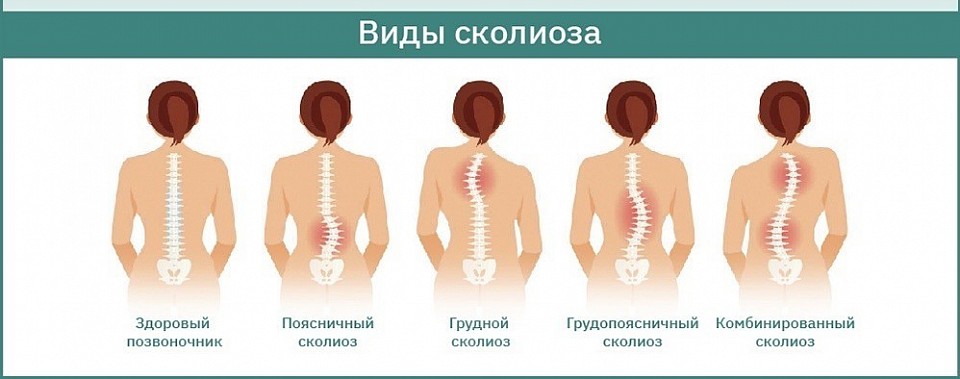 Какие виды сколиоза бывают